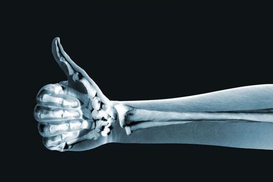 Parmak eklemlerindeki ağrıyı teşhis etmek için kullanılan röntgen