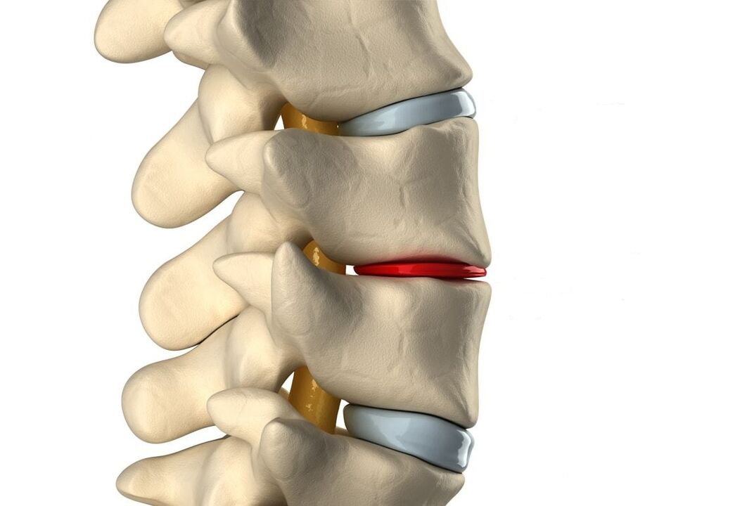 Sağlıklı intervertebral disk (mavi) ve torasik osteokondroz nedeniyle hasar görmüş (kırmızı)