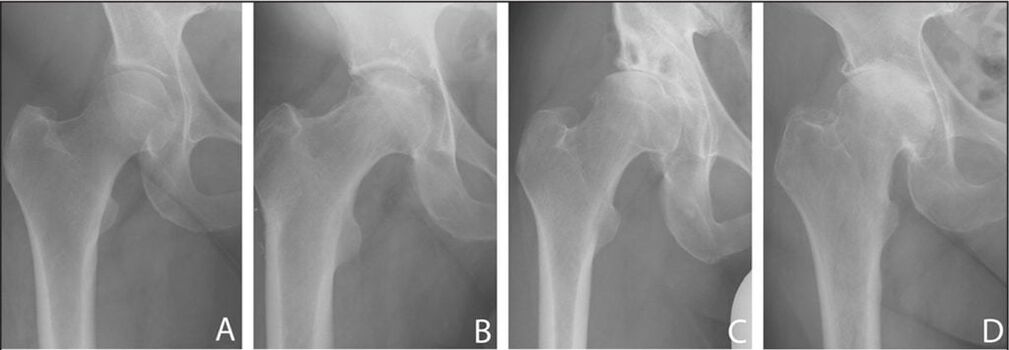 Röntgende kalça ekleminin osteoartritinin gelişim aşamaları