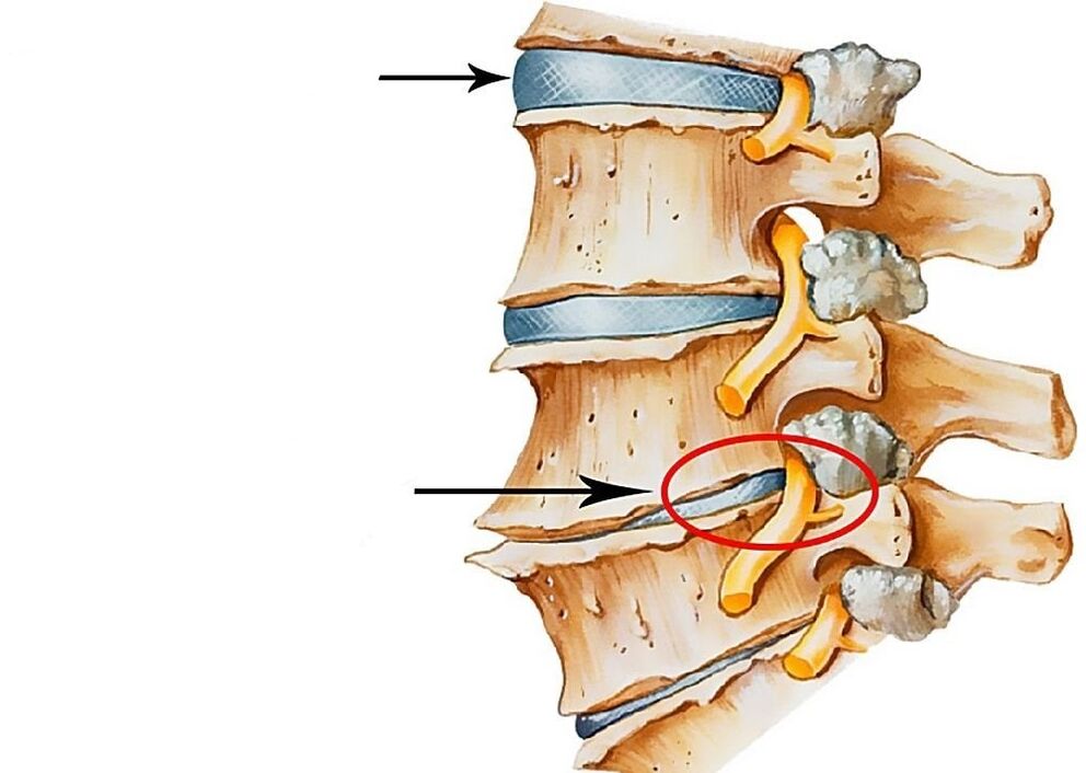 Sağlıklı ve deforme olmuş intervertebral disklerin temsili