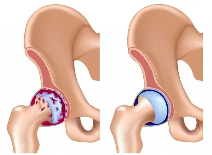 Osteoartrit nedeniyle kalça ekleminde hasar