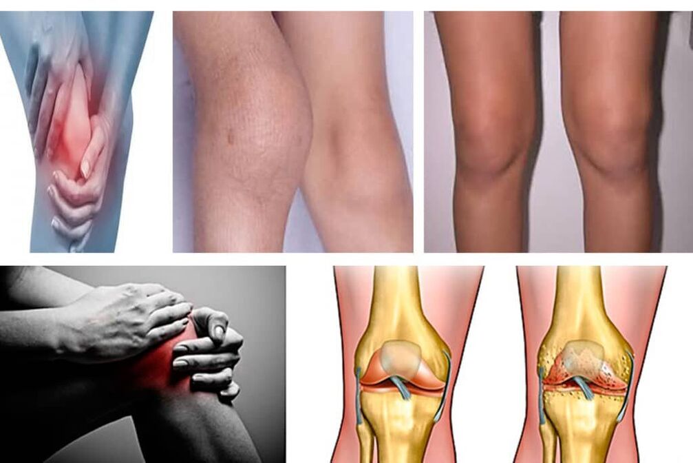 Osteoartrit nedir